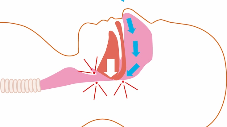 Diagram showing the blockage of upper airways during sleep